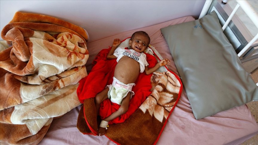 Yemen’de akut yetersiz beslenme sorunu çocukların hayatını karartıyor