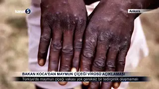 Bakan Koca’dan Maymun Çiçeği Virüsü Açıklaması