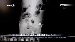 Midesinden 233 Parça Yabancı Cisim Çıkarılan Hasta