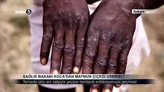 Sağlık Bakanı Koca’dan Maymun Çiçeği Uyarısı