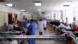 Türkiye’nin İlk Maymun Çiçeği Virüsü Vakası Açıklandı