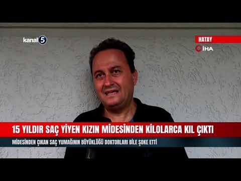15 Yıldır Saç Yiyen Kızın Midesinden Kilolarca Kıl Çıktı!